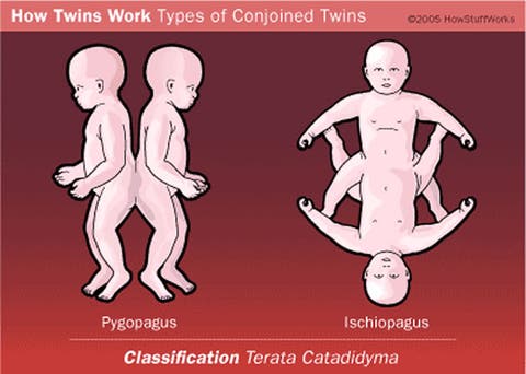 Nudist conjoined twins images