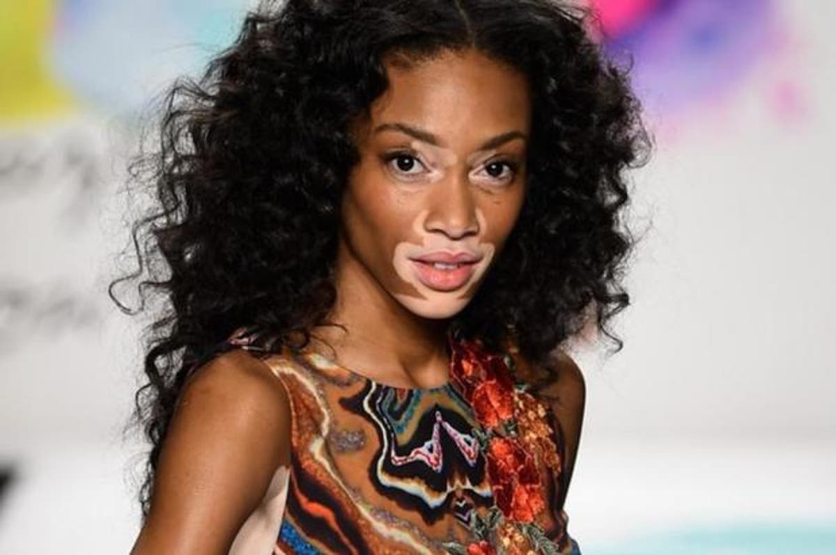 Total 105+ imagen modelo famosa que tiene vitiligo - Abzlocal.mx