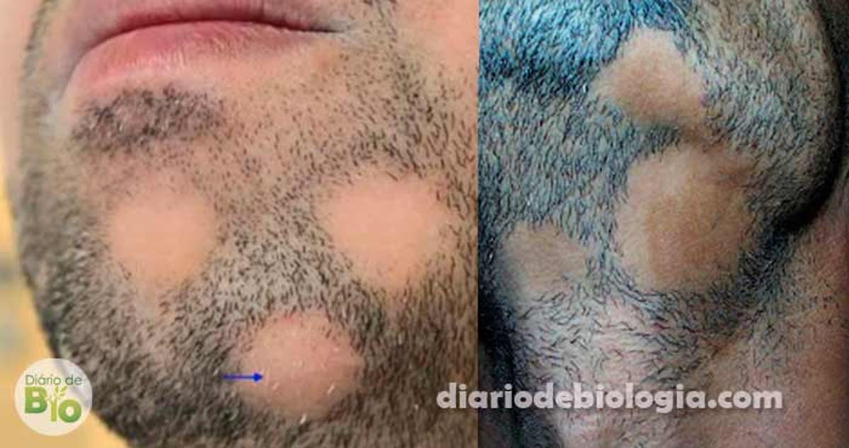 Alopecia Na Barba Falhas Circulares Por Perda De Pelo Causada Por Estresse Ou Doencas Auto Imunes Diario De Biologia