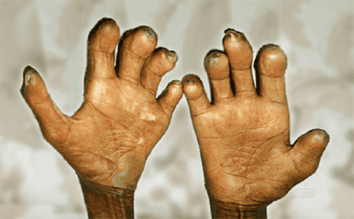 Plateau Records 103 Cases Of Leprosy In 2018 Says Commissioner