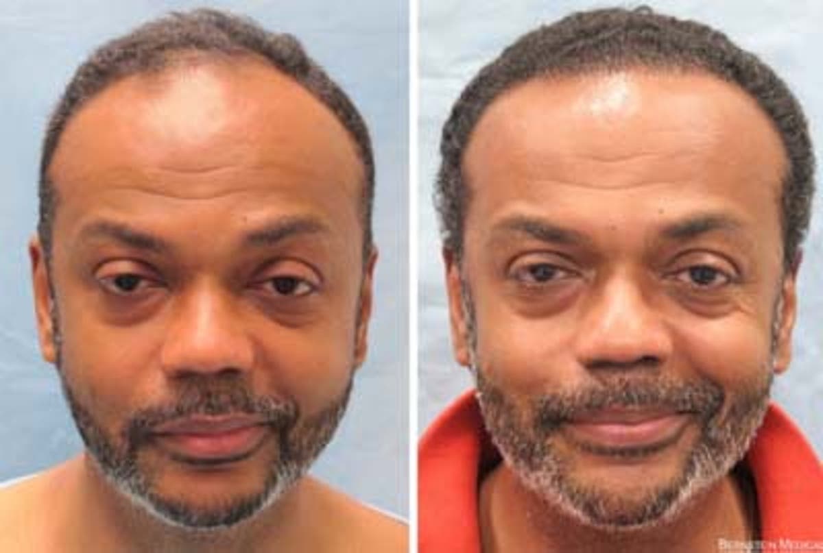 New Breakthrough Solution Leaves Men With Full Head Of Hair