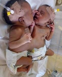 FG takes over medical expenses of Bayelsa conjoined twins, flies them to Yobe hospital