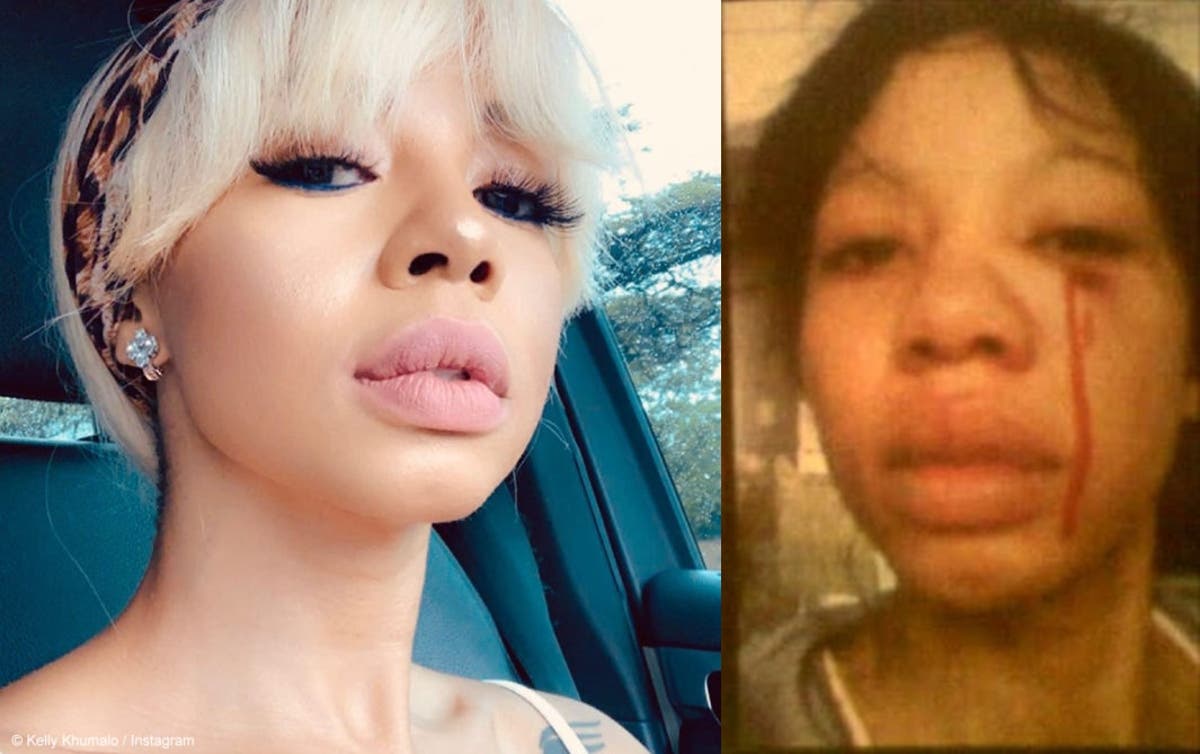 Kelly Khumalo And Jub Jub News . Heartbreaking Photos Of Abuse After Jub Jub Heavily Beat Kelly Khumalo News365 Co Za