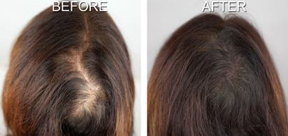 Going Bald Have A Scalp Tattoo Or Hair Transplant Vanguard News