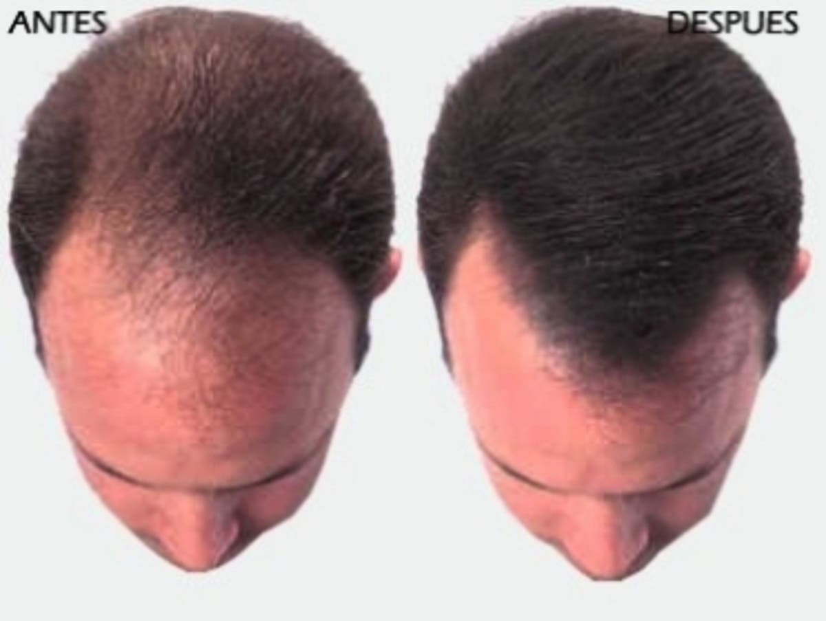 Digale Adios A La Calvicie Con El Injerto De Pelo