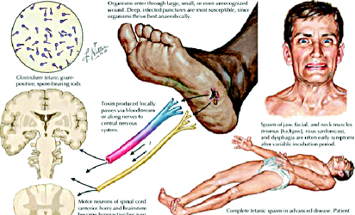 NATURE'S UNSEEN' KILLER: How not to be at the mercy of tetanus ...