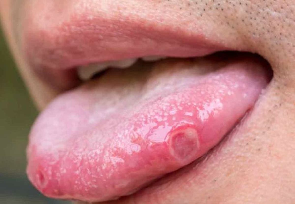 virus del papiloma humano linear unit los hombres sintomas