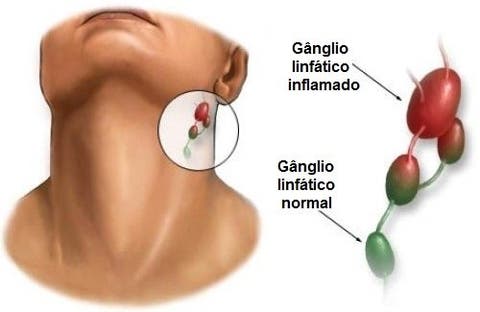 ganglios inflamados cancer de garganta
