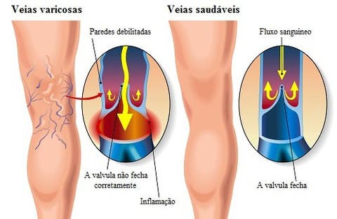 Quebradas nas coxas veias
