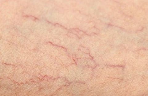 As quais veias vermelhas pequenas minhas pernas nas são