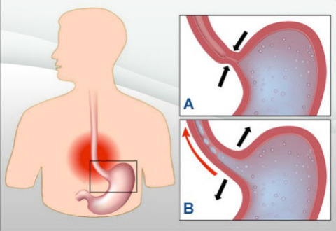 Dolor nocturno en la úlcera duodenal