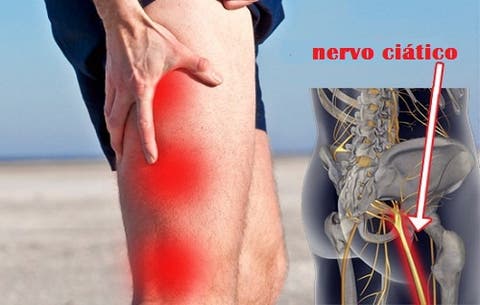 Tratar nervo problema do como ciático o