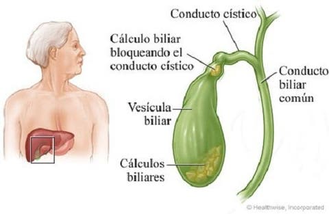 pedra na vesícula onde fica