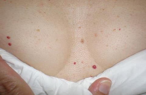 Veias varicosas nos testículos infertilidade
