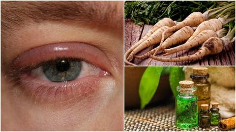 Para remédios edema naturais