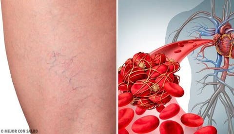 Doenças tromboflebite definir de