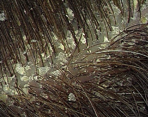 Top 15 Causes Of Dry Itchy Scalp Everyone Should Know About