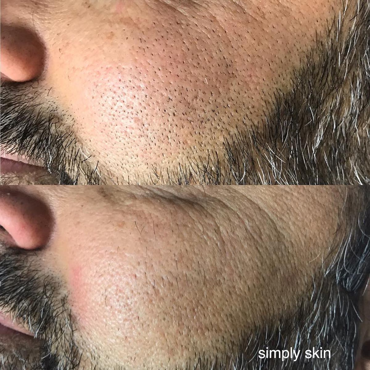 How To Remove And Treat Infected Ingrown Hair