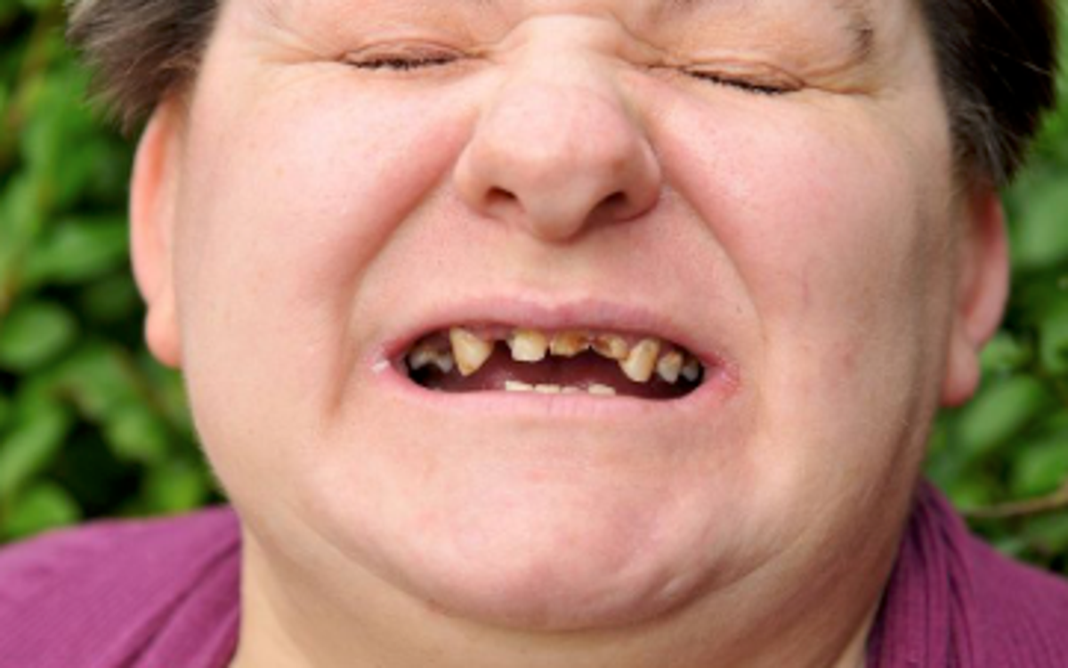 The Meaning Behind Dreams About Teeth Crumbling