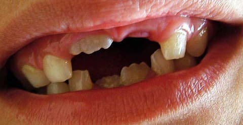 10 Most Common Reasons Why You Dream About Your Teeth Falling Out