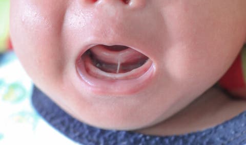 Anquiloglossia ou freio lingual curto nas crianças — Sou Mamãe