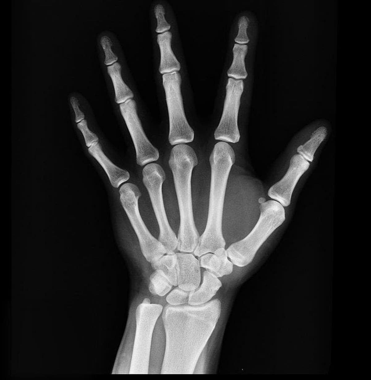 X Ray Radiation >> New Warning On Health Risks Of Low Levels Of X Ray Radiation X Ray Radiation >> New Warning On Health Risks Of Low Levels Of X Ray Radiation