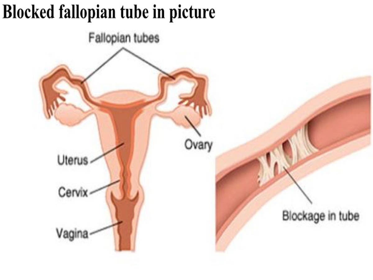 Can Hsg Cause Early Ovulation Glow Community