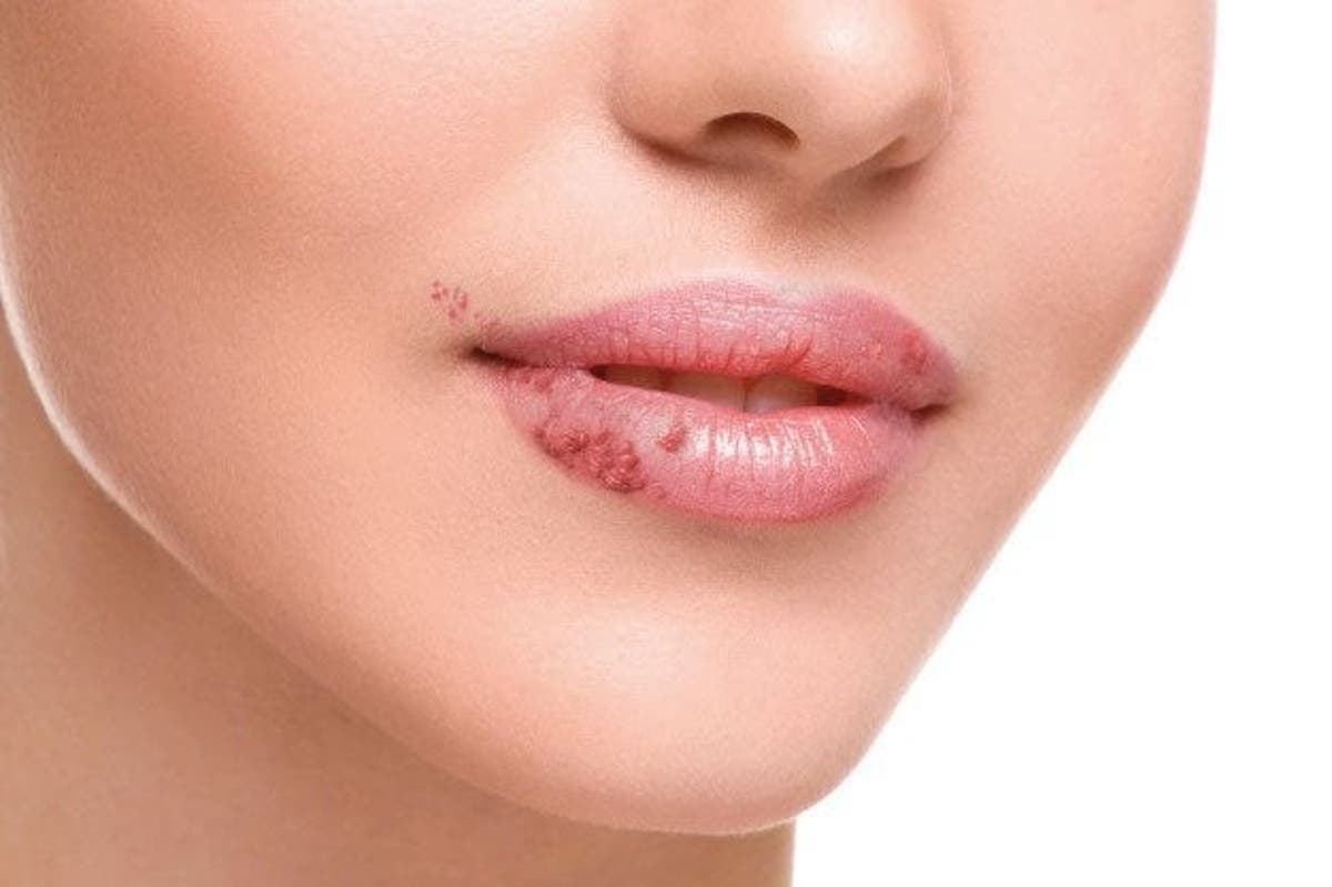 Que Es La Quelitis Afecta Los Labios Tan Doloroso Como Incomodo