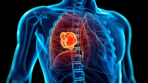 Cáncer de pulmón