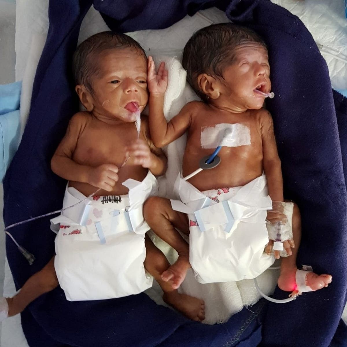 Micro Preemie Twin Babies Born At 24 Weeks Weighing 600g And 6g Become Smallest To Survive Real Fix Magazine Micro Preemie Twin Babies Born At 24 Weeks Weighing 600g And 6g Become Smallest To Survive Real Fix Magazine