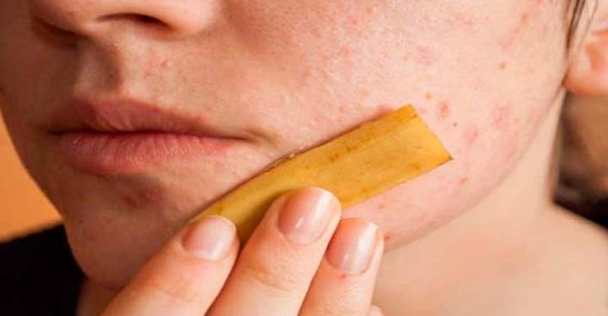 beneficios de frotar cascara de platano en la cara